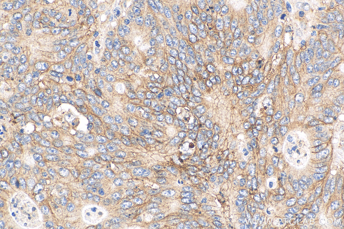 Immunohistochemistry (IHC) staining of human colon cancer tissue using CD9 Monoclonal antibody (60232-1-Ig)