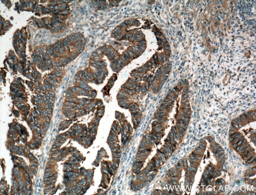 IHC staining of human colon cancer using 60232-1-Ig