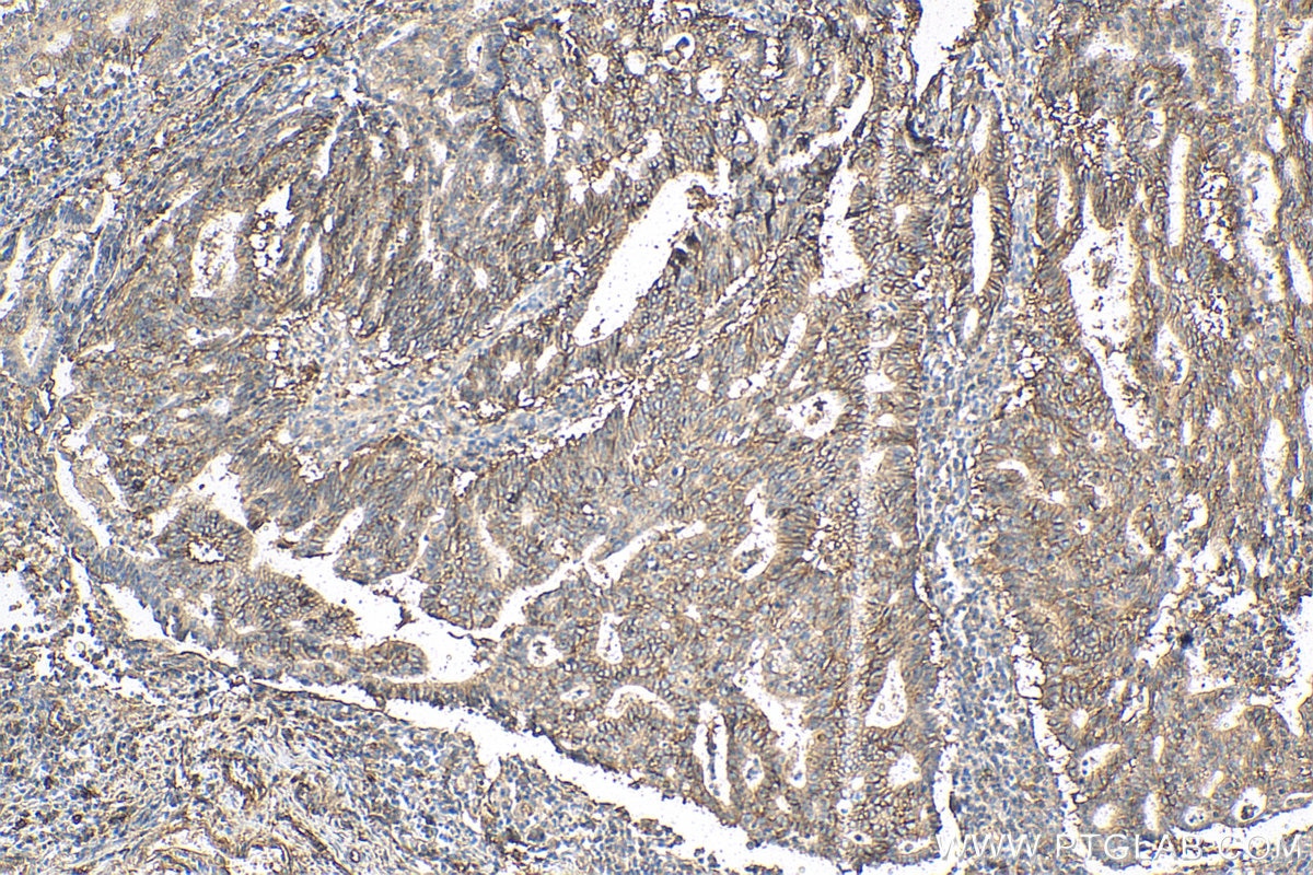 Immunohistochemistry (IHC) staining of human endometrial cancer tissue using CD9 Recombinant antibody (82105-1-RR)