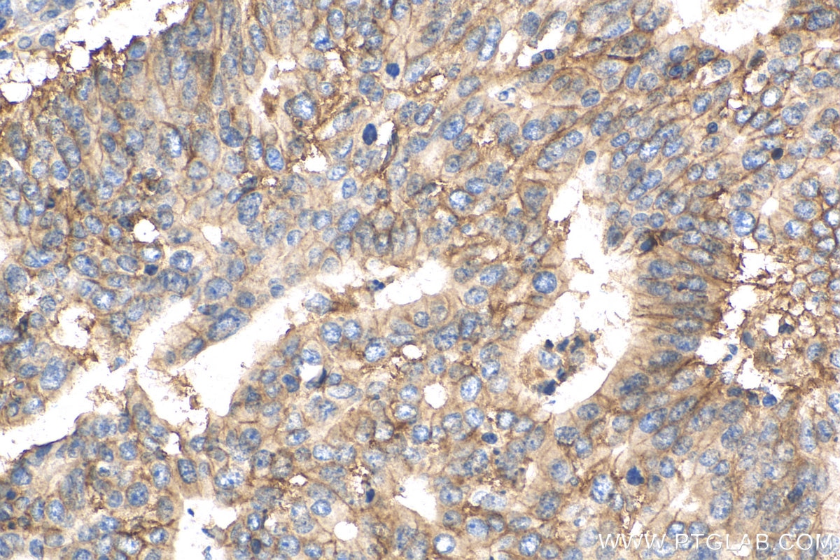 Immunohistochemistry (IHC) staining of human endometrial cancer tissue using CD9 Recombinant antibody (82105-1-RR)