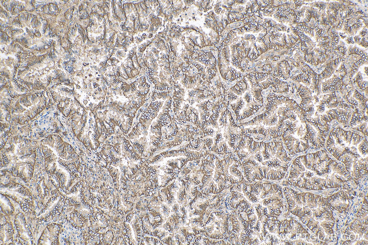 Immunohistochemistry (IHC) staining of human lung cancer tissue using CD9 Recombinant antibody (82105-1-RR)