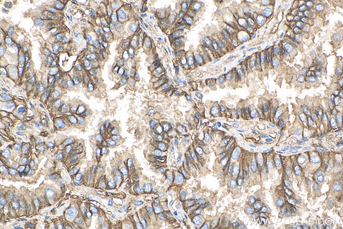 Immunohistochemistry (IHC) staining of human lung cancer tissue using CD9 Recombinant antibody (82105-1-RR)