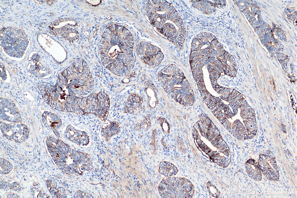 Immunohistochemistry (IHC) staining of human prostate cancer tissue using CD9 Recombinant antibody (84801-13-RR)