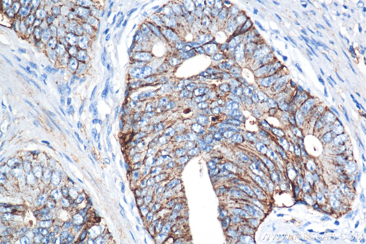 Immunohistochemistry (IHC) staining of human prostate cancer tissue using CD9 Recombinant antibody (84801-13-RR)
