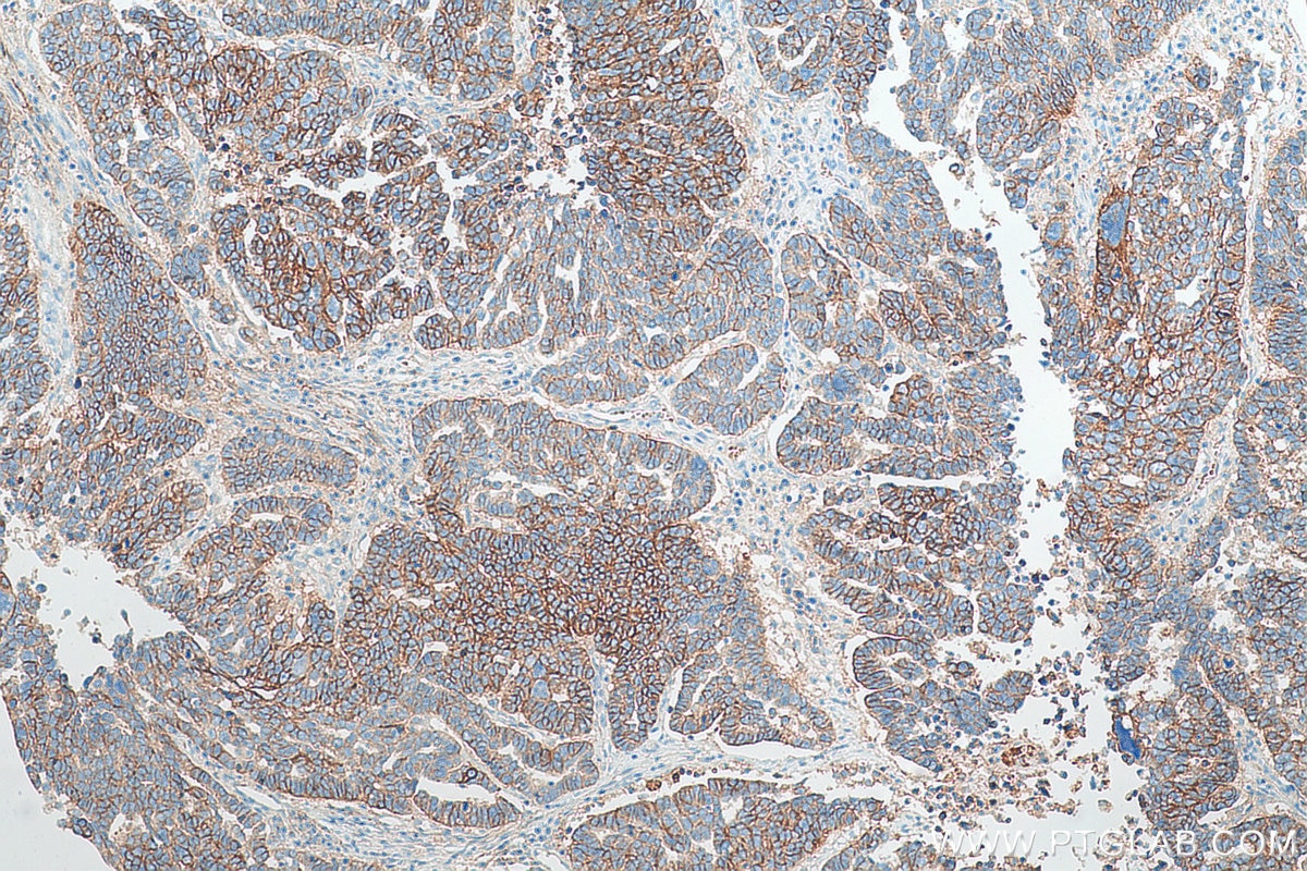 Immunohistochemistry (IHC) staining of human ovary tumor tissue using Biotin-conjugated CD9 Monoclonal antibody (Biotin-60232)