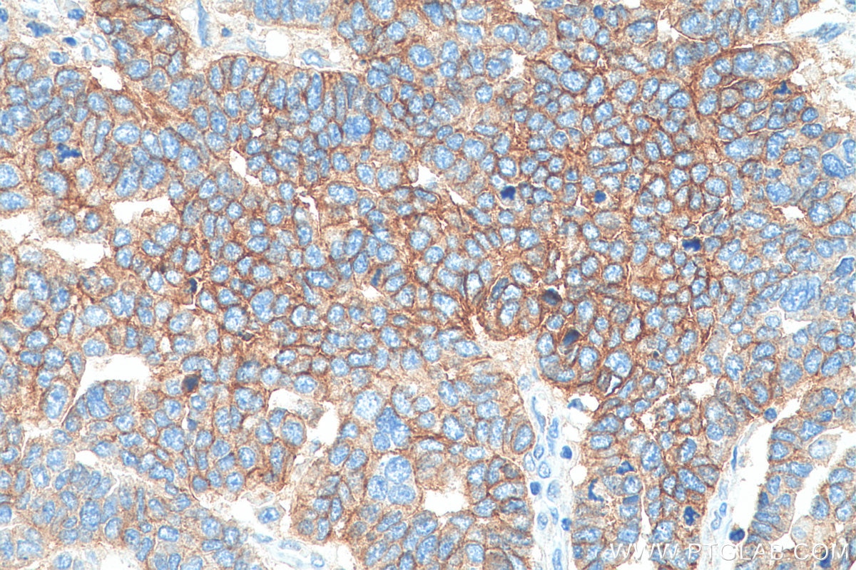 Immunohistochemistry (IHC) staining of human ovary tumor tissue using Biotin-conjugated CD9 Monoclonal antibody (Biotin-60232)