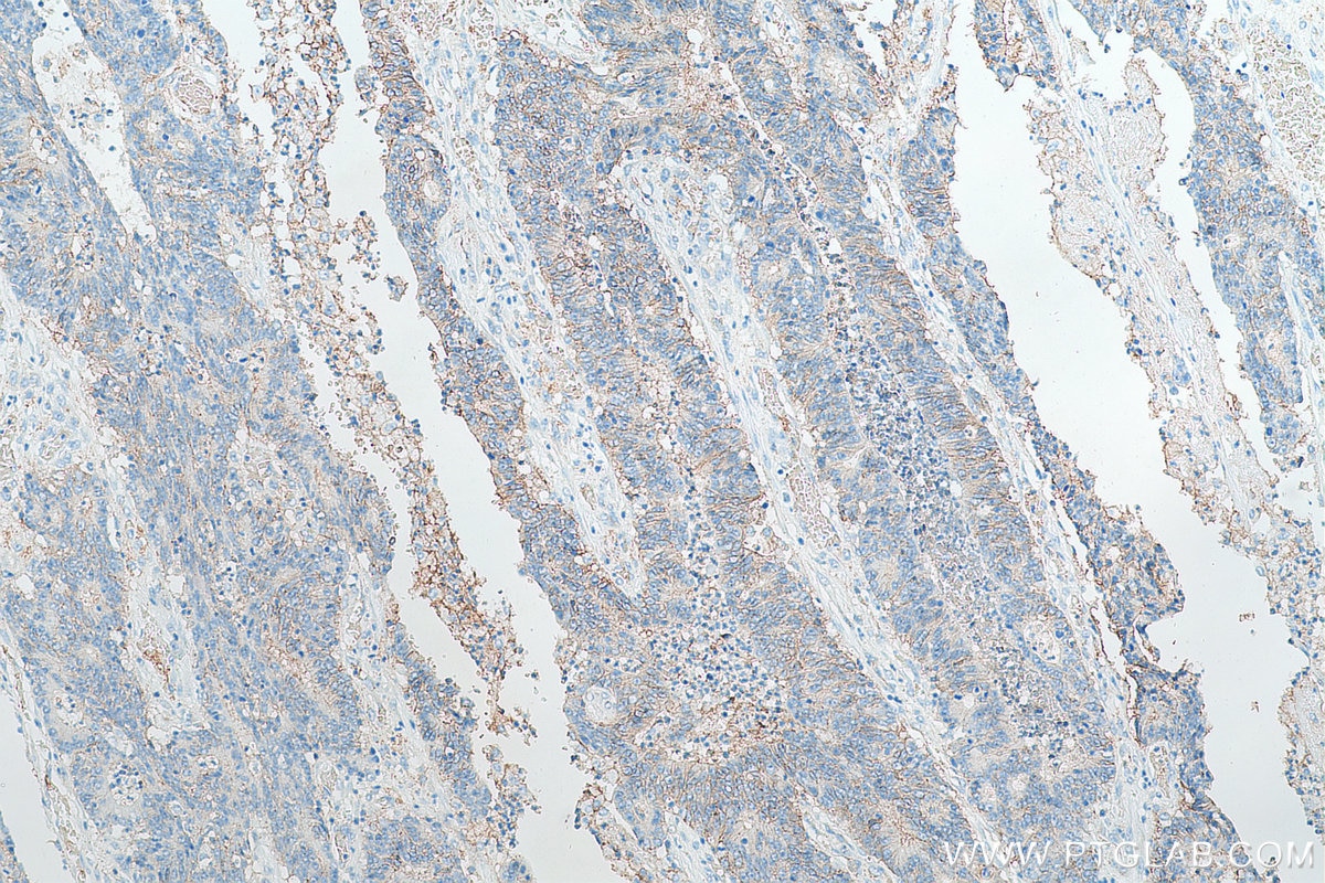 IHC staining of human colon cancer using Biotin-60232