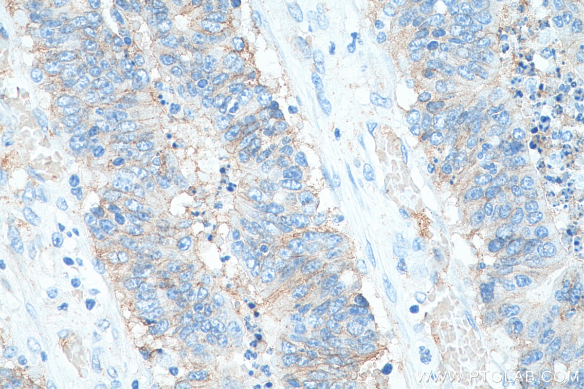 Immunohistochemistry (IHC) staining of human colon cancer tissue using Biotin-conjugated CD9 Monoclonal antibody (Biotin-60232)