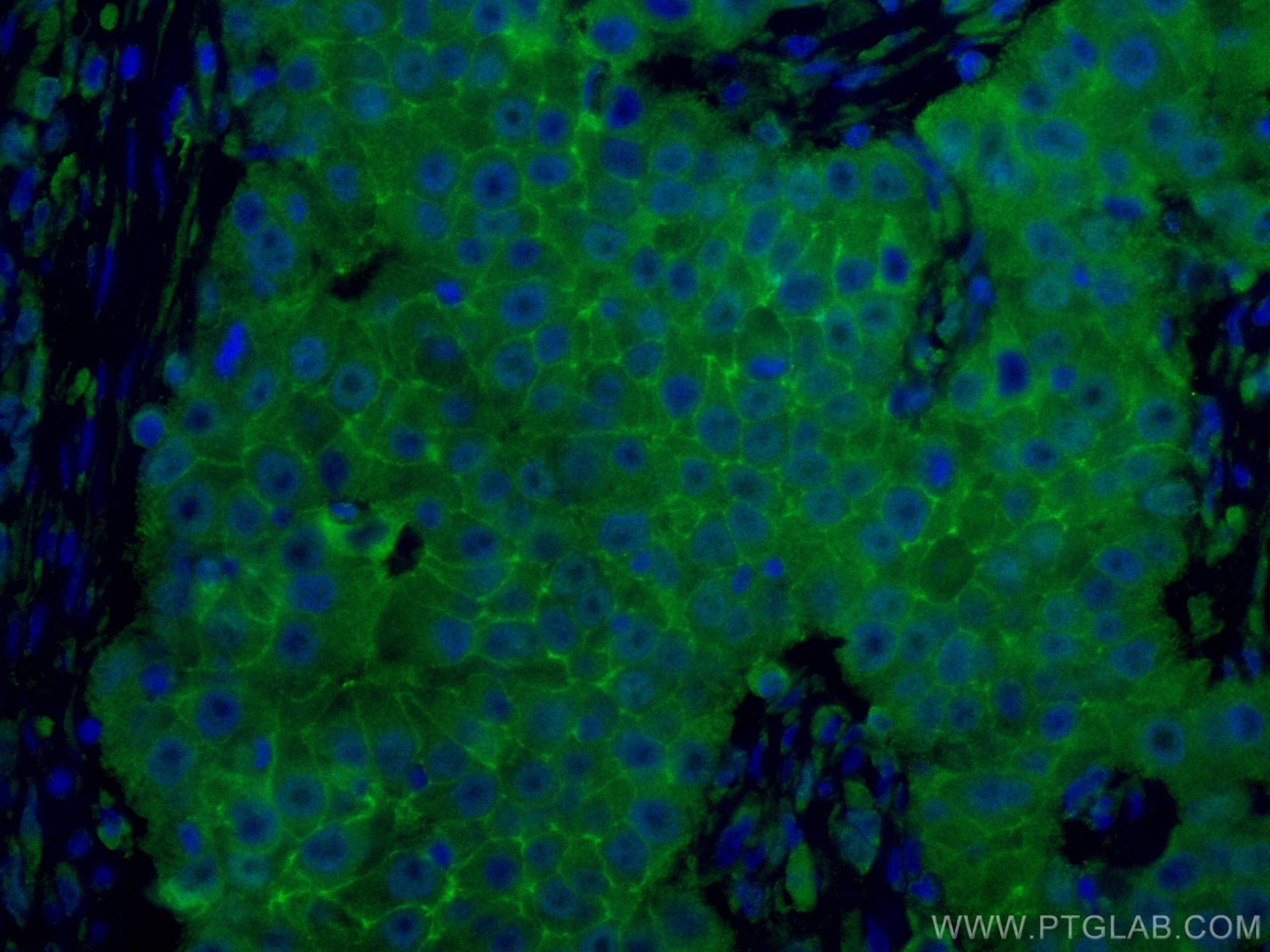 IF Staining of human breast cancer using CL488-60232