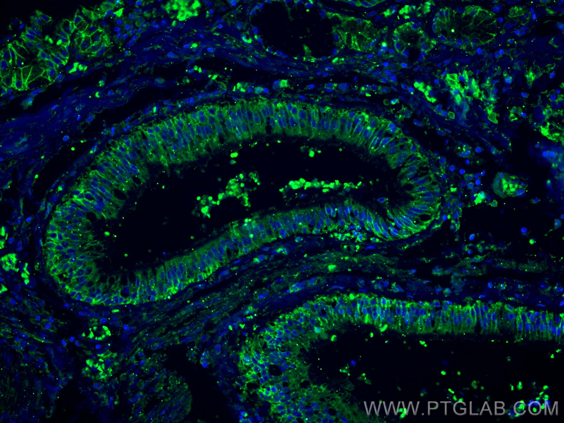 Immunofluorescence (IF) / fluorescent staining of human lung cancer tissue using CoraLite® Plus 488-conjugated CD9 Monoclonal antib (CL488-60232)