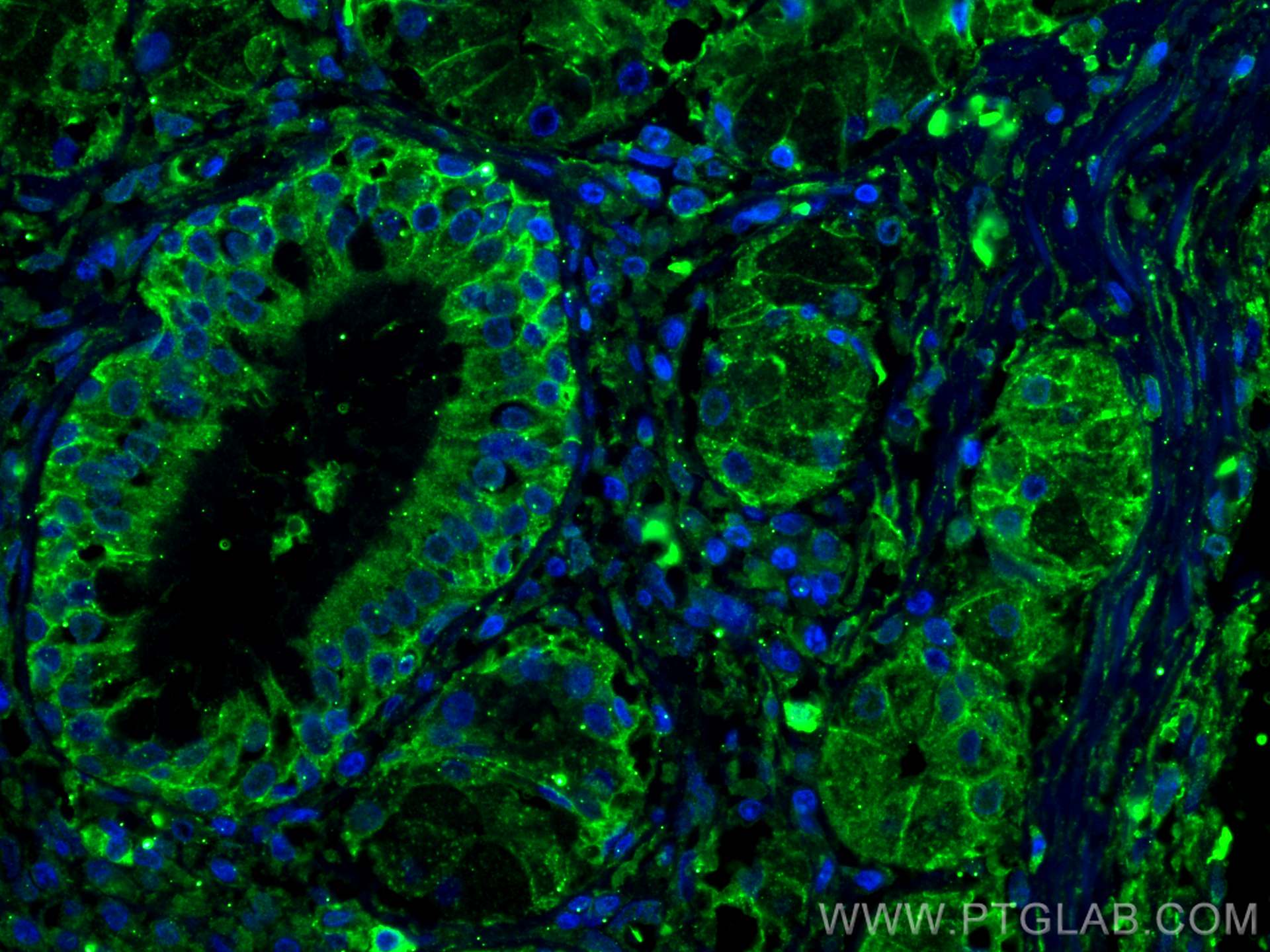Immunofluorescence (IF) / fluorescent staining of human lung cancer tissue using CoraLite® Plus 488-conjugated CD9 Monoclonal antib (CL488-60232)