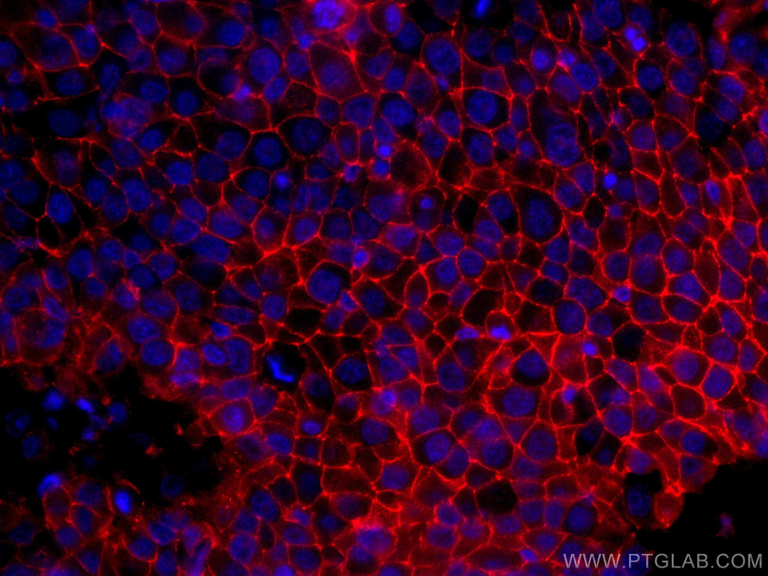 Immunofluorescence (IF) / fluorescent staining of human breast cancer tissue using CoraLite®594-conjugated CD9 Monoclonal antibody (CL594-60232)