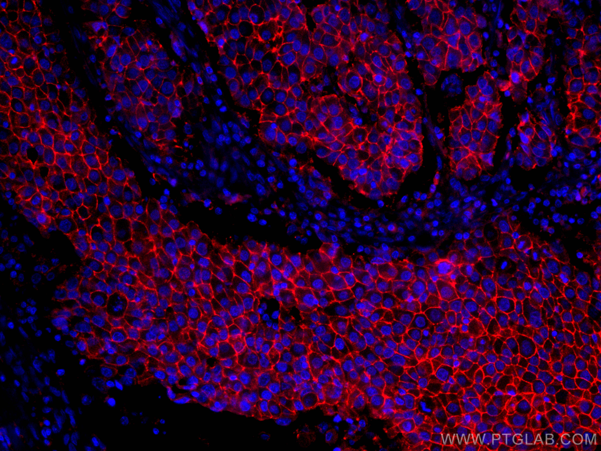 Immunofluorescence (IF) / fluorescent staining of human breast cancer tissue using CoraLite®594-conjugated CD9 Monoclonal antibody (CL594-60232)