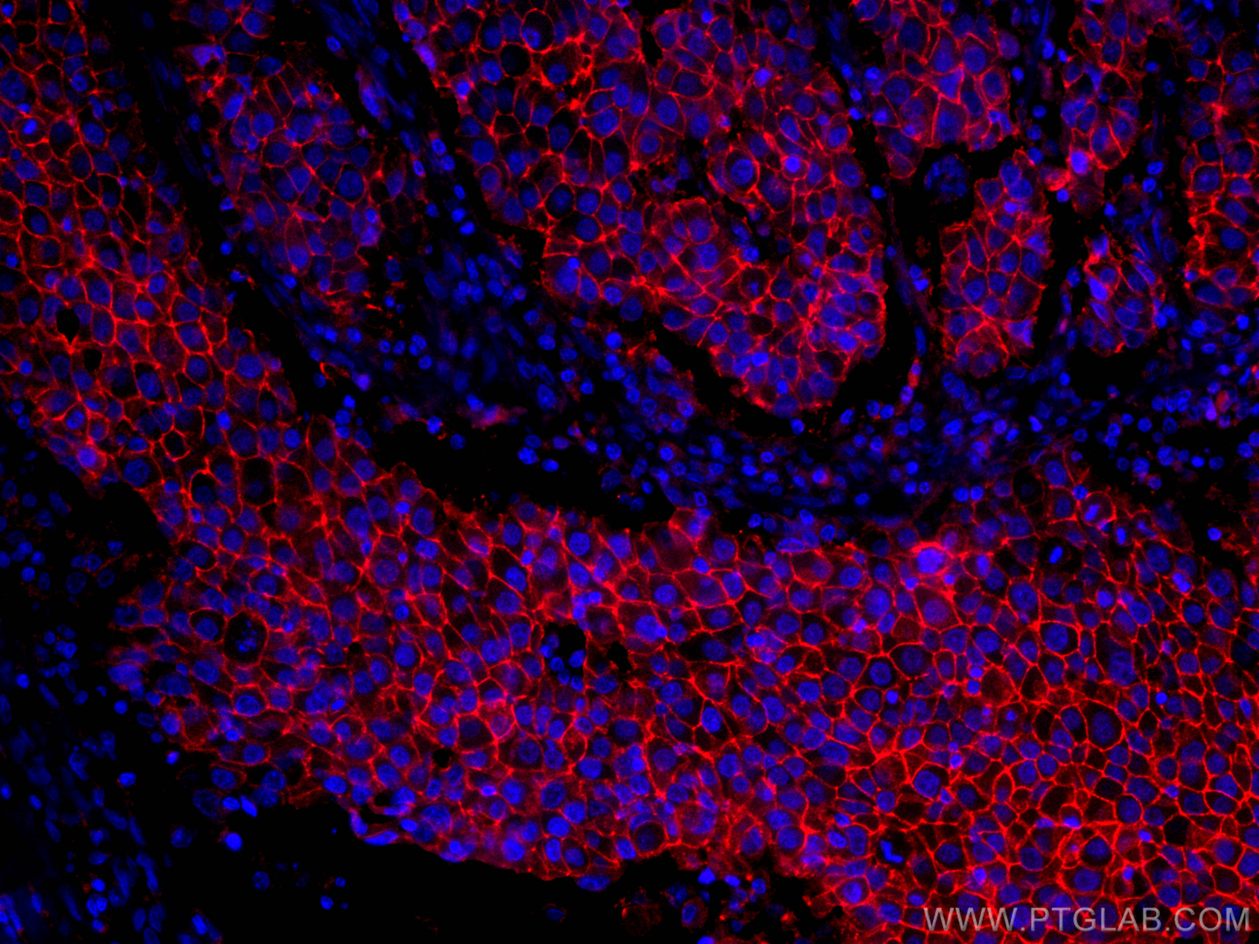 IF Staining of human breast cancer using CL594-60232