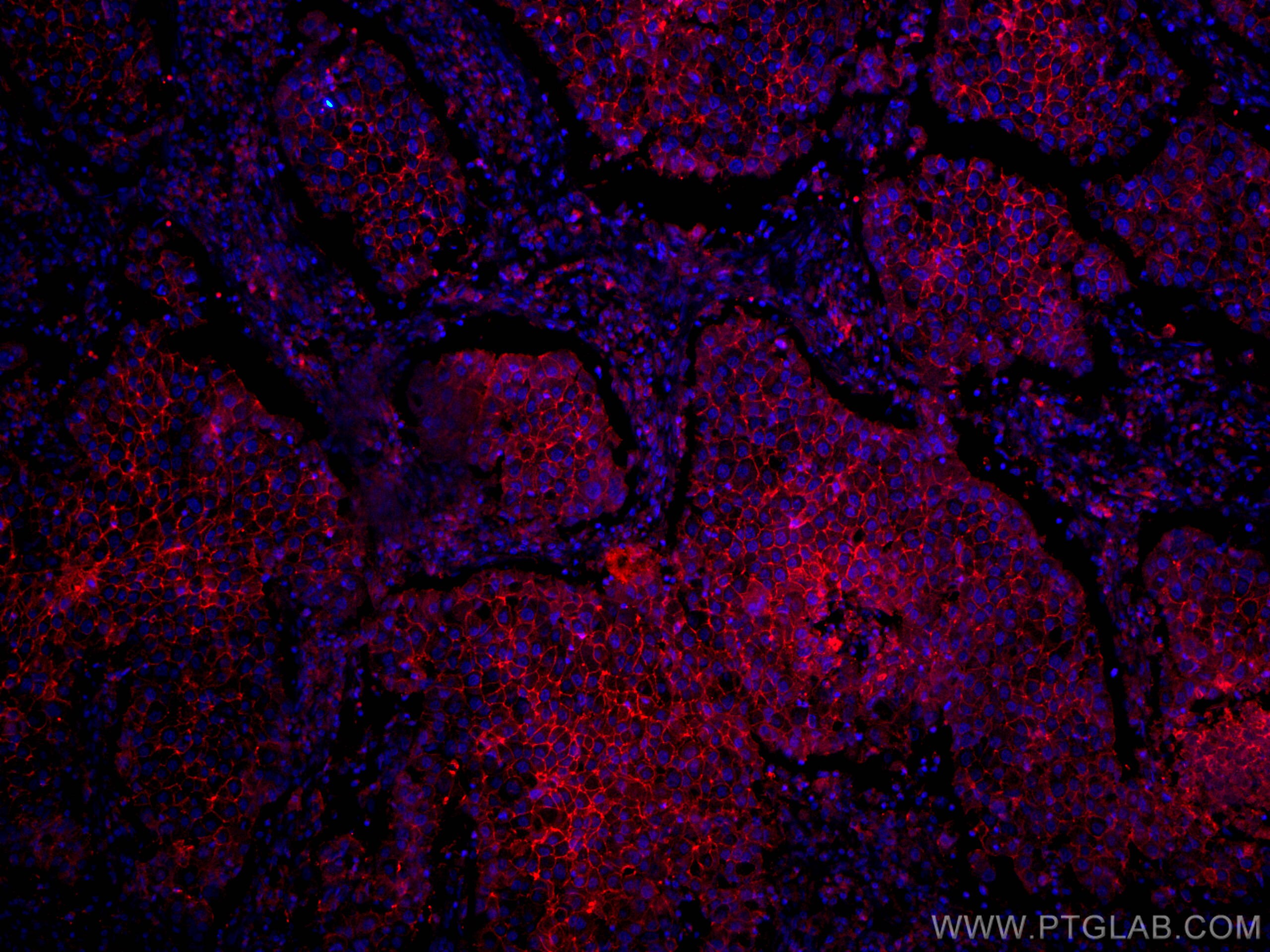 Immunofluorescence (IF) / fluorescent staining of human breast cancer tissue using CoraLite®594-conjugated CD9 Monoclonal antibody (CL594-60232)