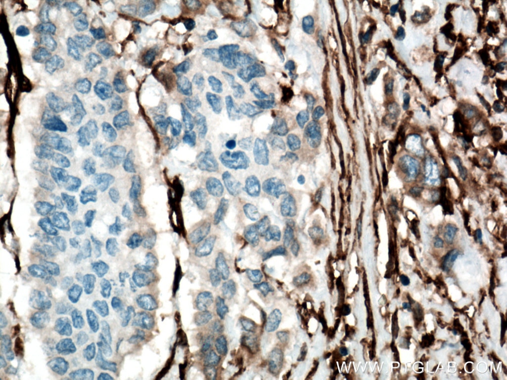 Immunohistochemistry (IHC) staining of human colon cancer tissue using CD90 Monoclonal antibody (66766-1-Ig)