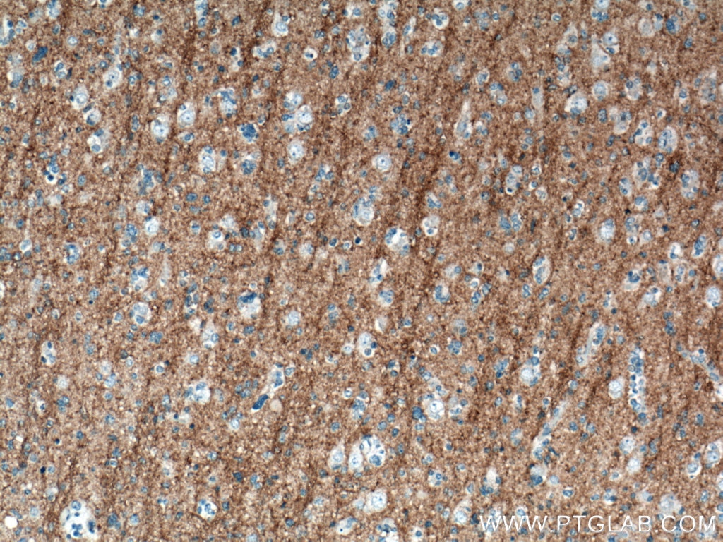 Immunohistochemistry (IHC) staining of human gliomas tissue using CD90 Monoclonal antibody (66766-1-Ig)