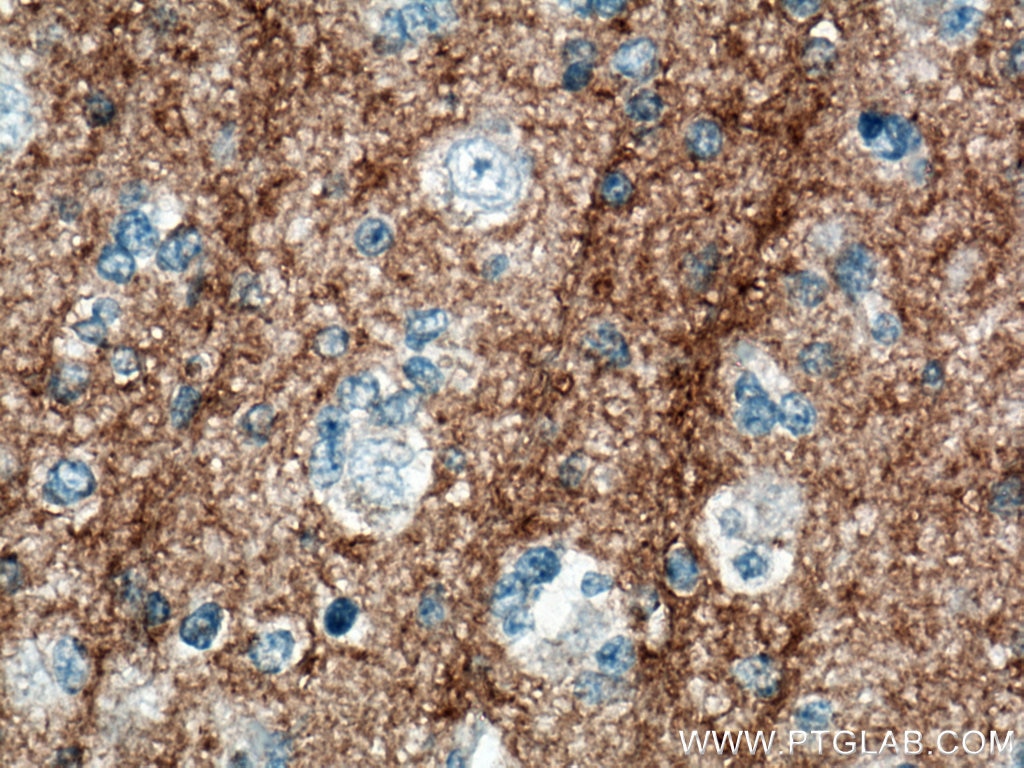 Immunohistochemistry (IHC) staining of human gliomas tissue using CD90 Monoclonal antibody (66766-1-Ig)