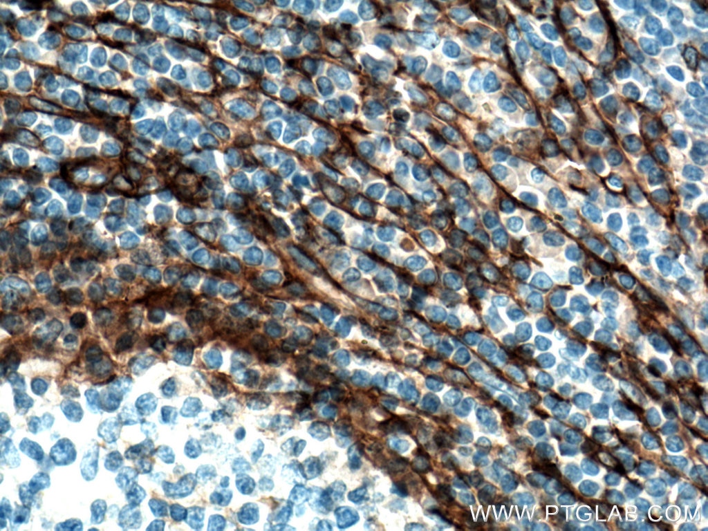 Immunohistochemistry (IHC) staining of human tonsillitis tissue using CD90 Monoclonal antibody (66766-1-Ig)