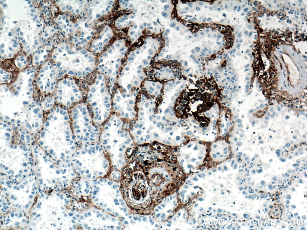 Immunohistochemistry (IHC) staining of human lung cancer tissue using CD90 Monoclonal antibody (66766-1-Ig)