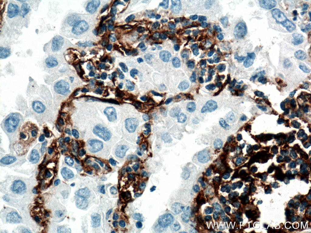 Immunohistochemistry (IHC) staining of human lung cancer tissue using CD90 Monoclonal antibody (66766-1-Ig)