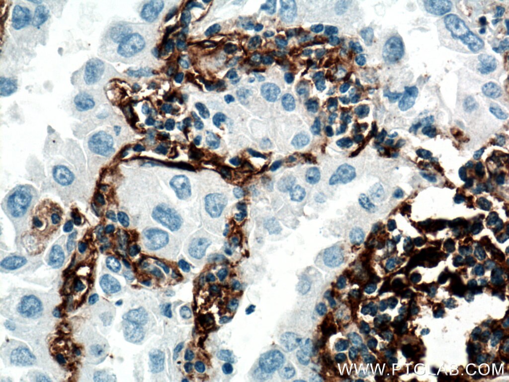 IHC staining of human lung cancer using 66766-1-Ig