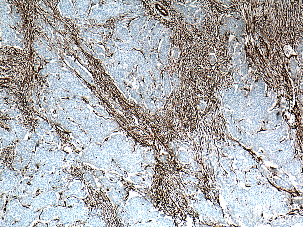 Immunohistochemistry (IHC) staining of human colon cancer tissue using CD90 Monoclonal antibody (66766-1-Ig)