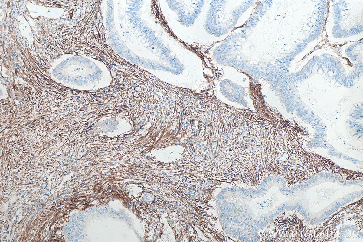 Immunohistochemistry (IHC) staining of human colon cancer tissue using CD90 Monoclonal antibody (66766-1-Ig)