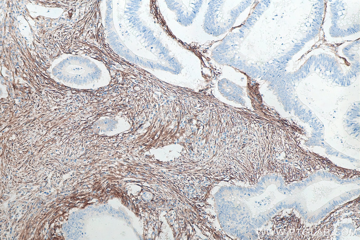 IHC staining of human colon cancer using 66766-1-Ig