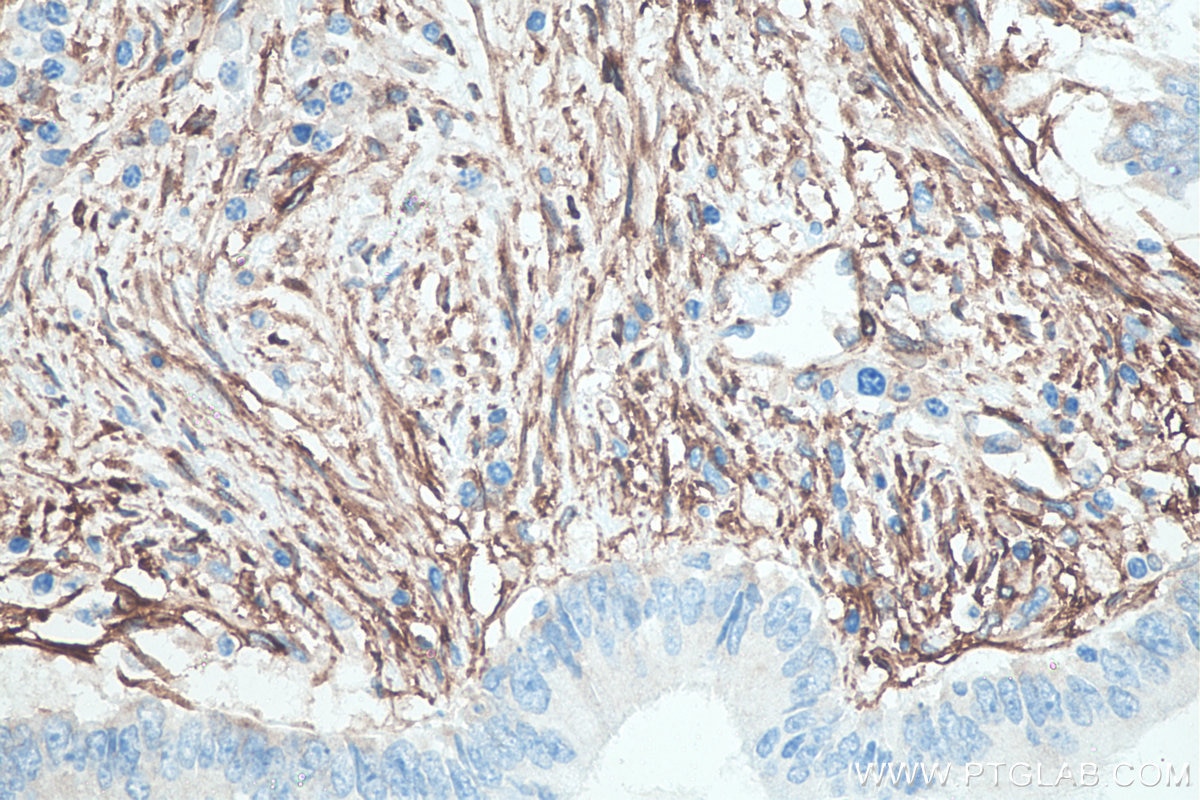 Immunohistochemistry (IHC) staining of human colon cancer tissue using CD90 Monoclonal antibody (66766-1-Ig)