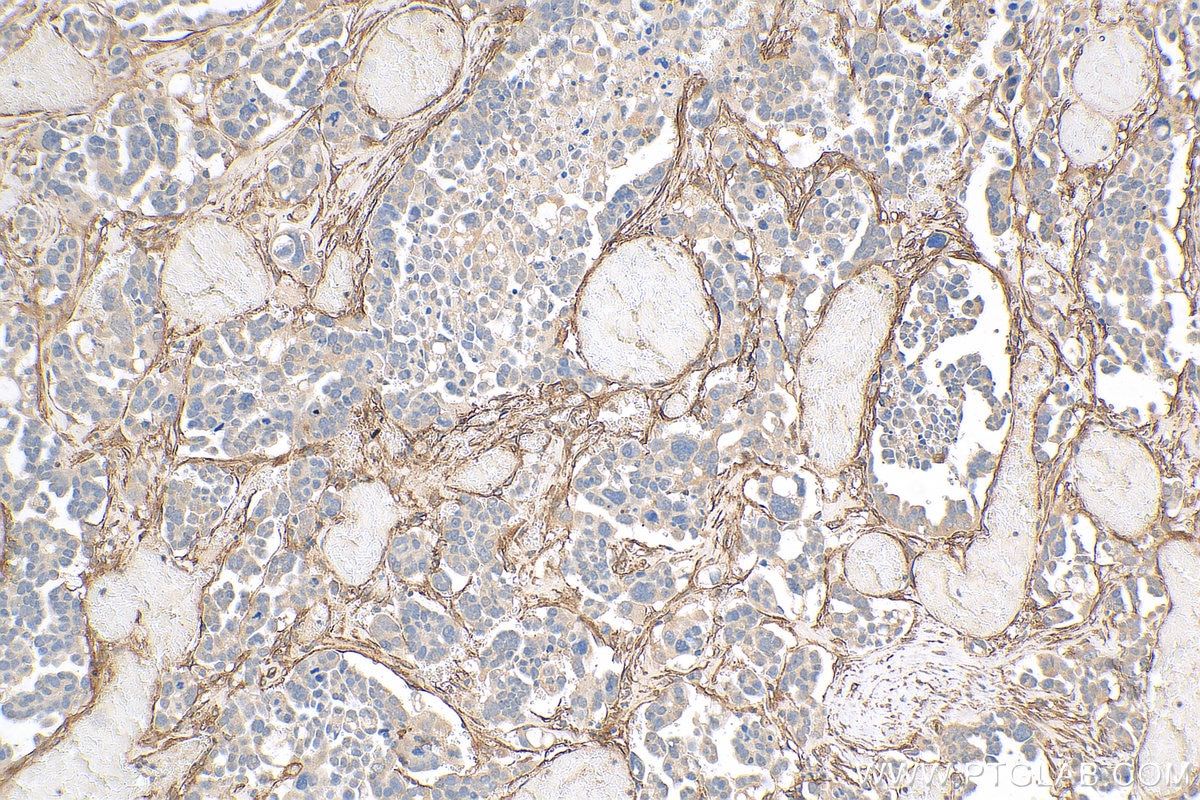 Immunohistochemistry (IHC) staining of human colon cancer tissue using CD90 / Thy1 Polyclonal antibody (27178-1-AP)