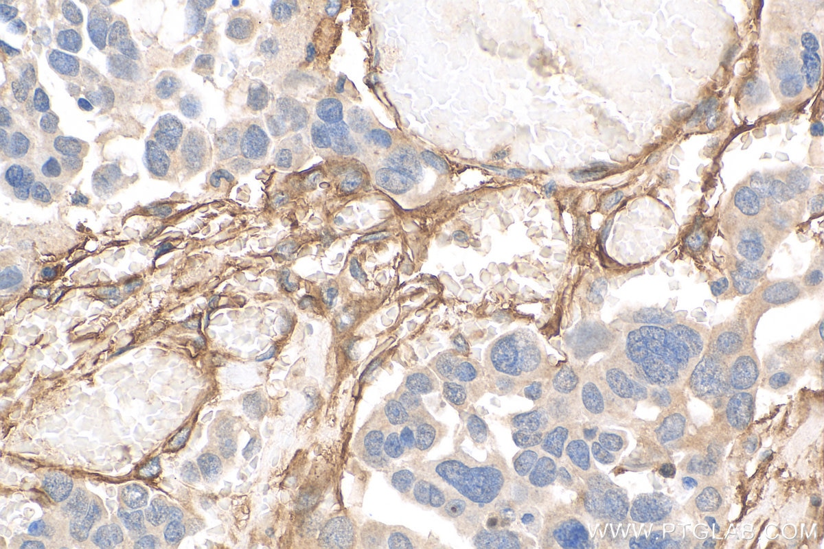 Immunohistochemistry (IHC) staining of human colon cancer tissue using CD90 / Thy1 Polyclonal antibody (27178-1-AP)