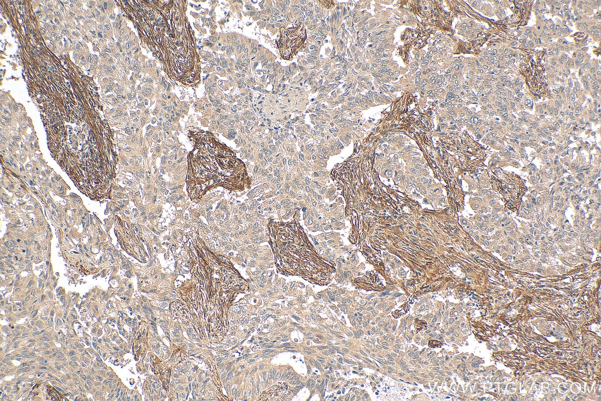 Immunohistochemistry (IHC) staining of human lung cancer tissue using CD90 / Thy1 Polyclonal antibody (27178-1-AP)
