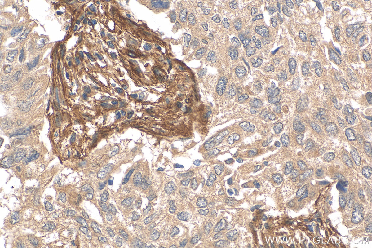Immunohistochemistry (IHC) staining of human lung cancer tissue using CD90 / Thy1 Polyclonal antibody (27178-1-AP)