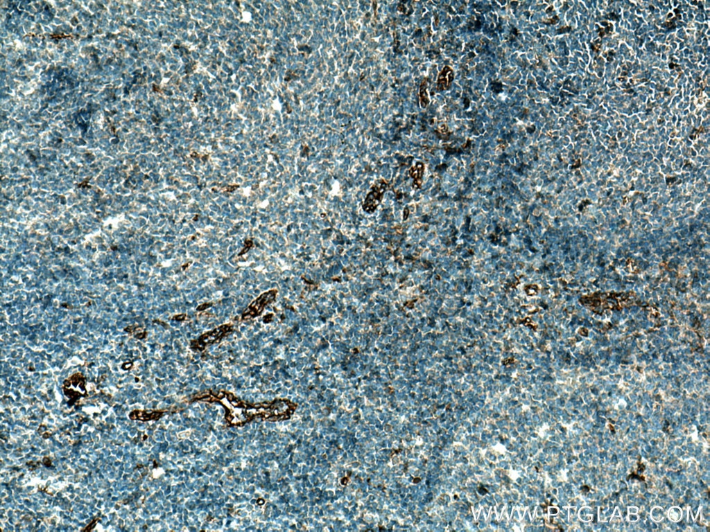 Immunohistochemistry (IHC) staining of human tonsillitis tissue using CD93 Polyclonal antibody (18283-1-AP)