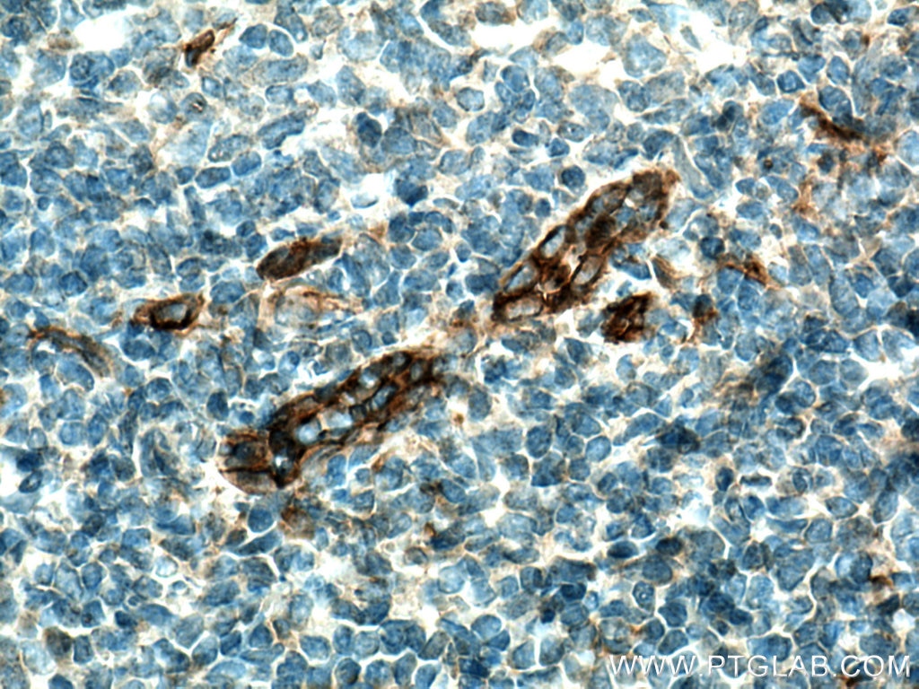 Immunohistochemistry (IHC) staining of human tonsillitis tissue using CD93 Polyclonal antibody (18283-1-AP)