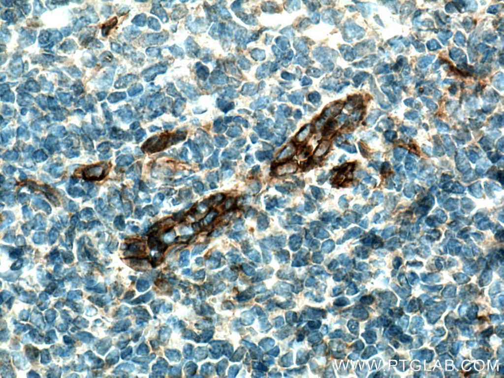 IHC staining of human tonsillitis using 18283-1-AP