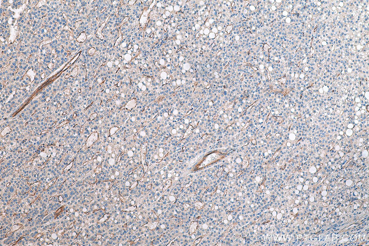 Immunohistochemistry (IHC) staining of human liver cancer tissue using CD93 Polyclonal antibody (18283-1-AP)