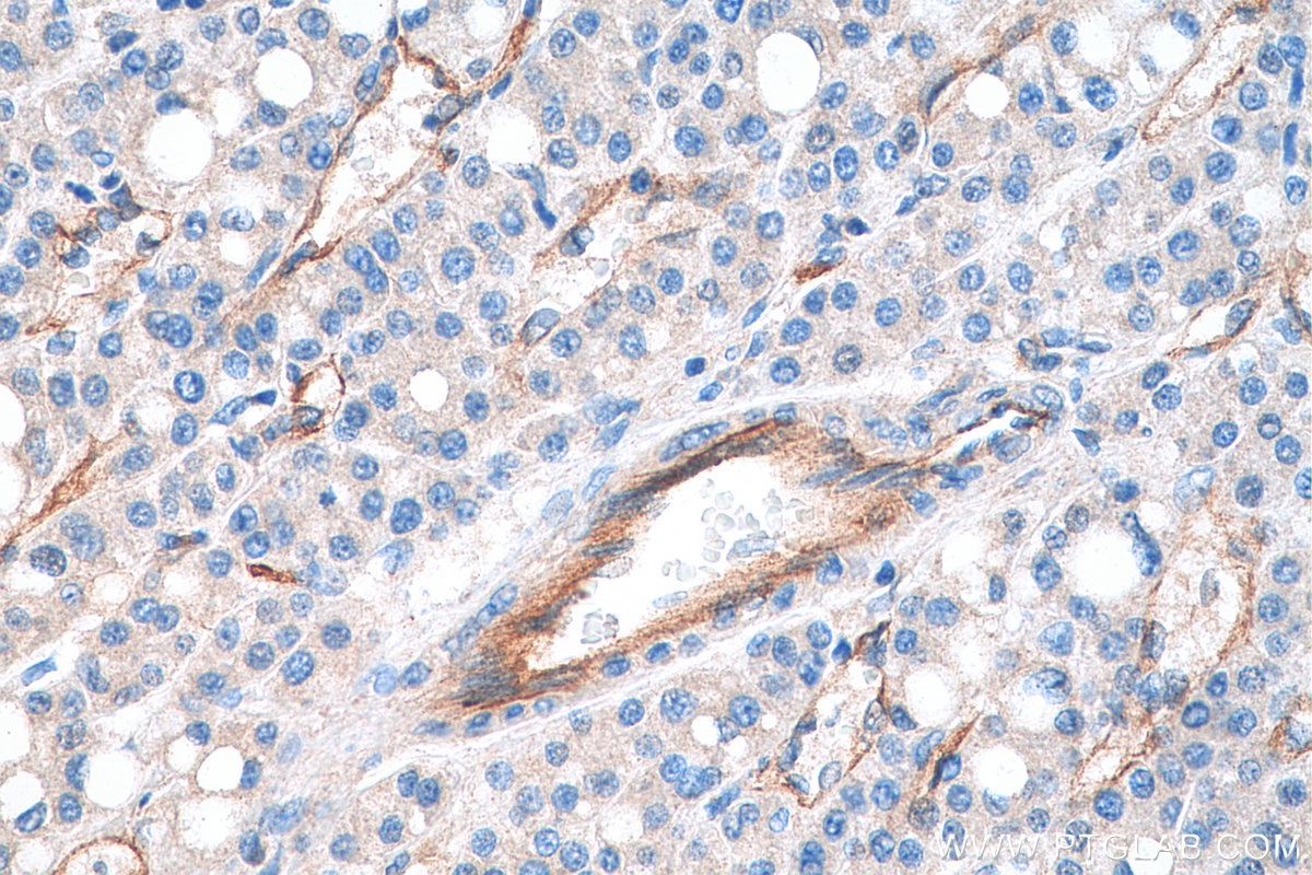 Immunohistochemistry (IHC) staining of human liver cancer tissue using CD93 Polyclonal antibody (18283-1-AP)
