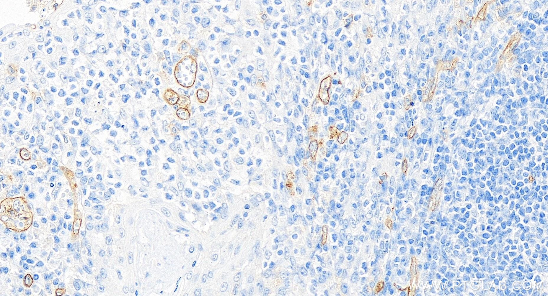 Immunohistochemistry (IHC) staining of human tonsillitis tissue using CD93 Recombinant antibody (84945-4-RR)