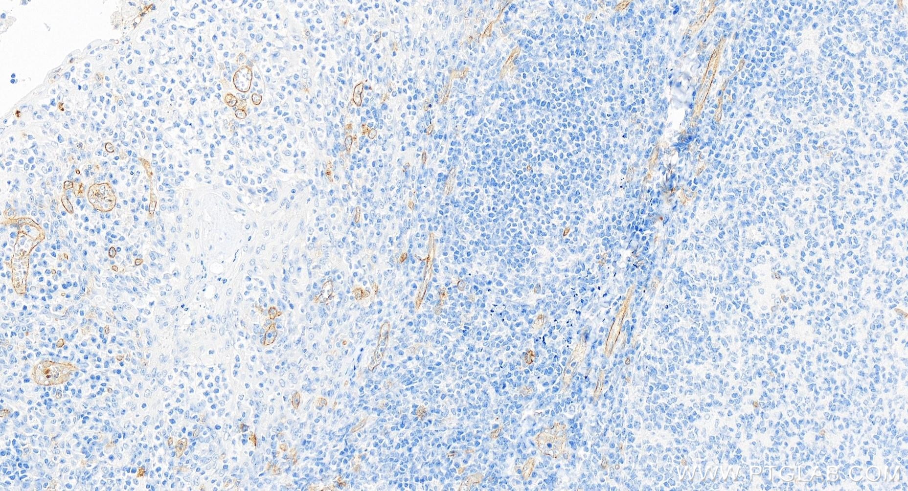 Immunohistochemistry (IHC) staining of human tonsillitis tissue using CD93 Recombinant antibody (84945-4-RR)