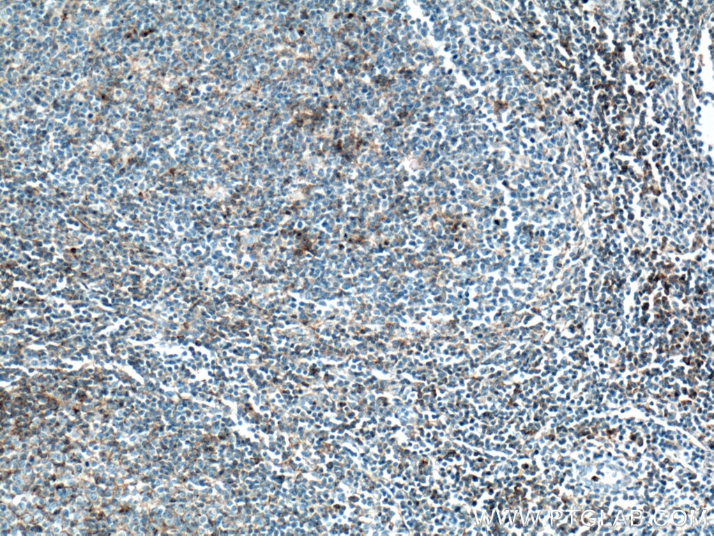 Immunohistochemistry (IHC) staining of human tonsillitis tissue using CD97 Polyclonal antibody (13071-1-AP)