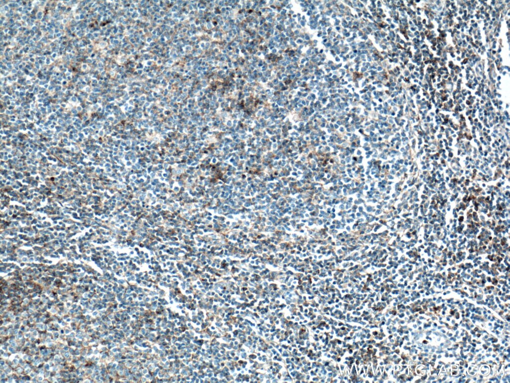 IHC staining of human tonsillitis using 13071-1-AP