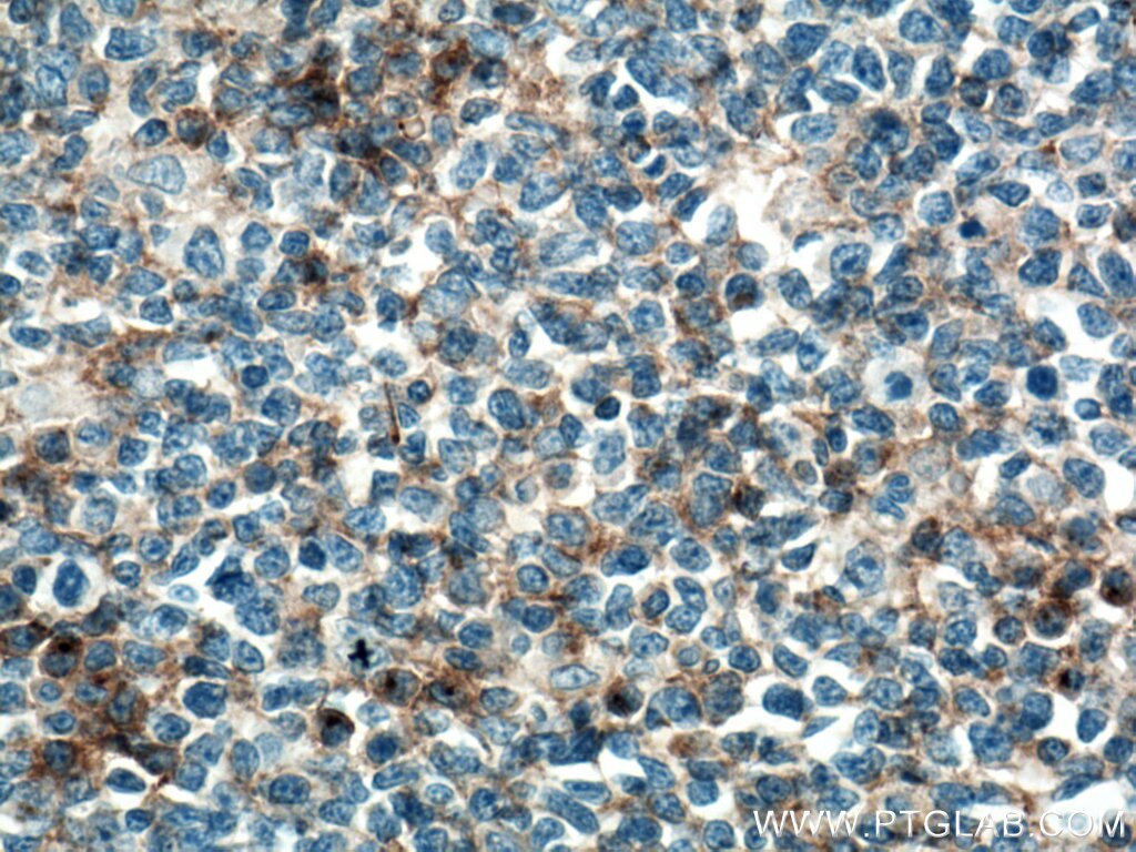 Immunohistochemistry (IHC) staining of human tonsillitis tissue using CD97 Polyclonal antibody (13071-1-AP)