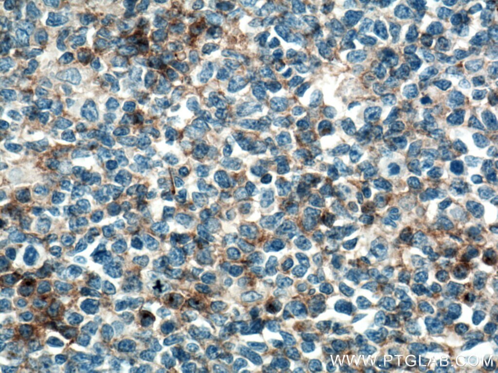 IHC staining of human tonsillitis using 13071-1-AP