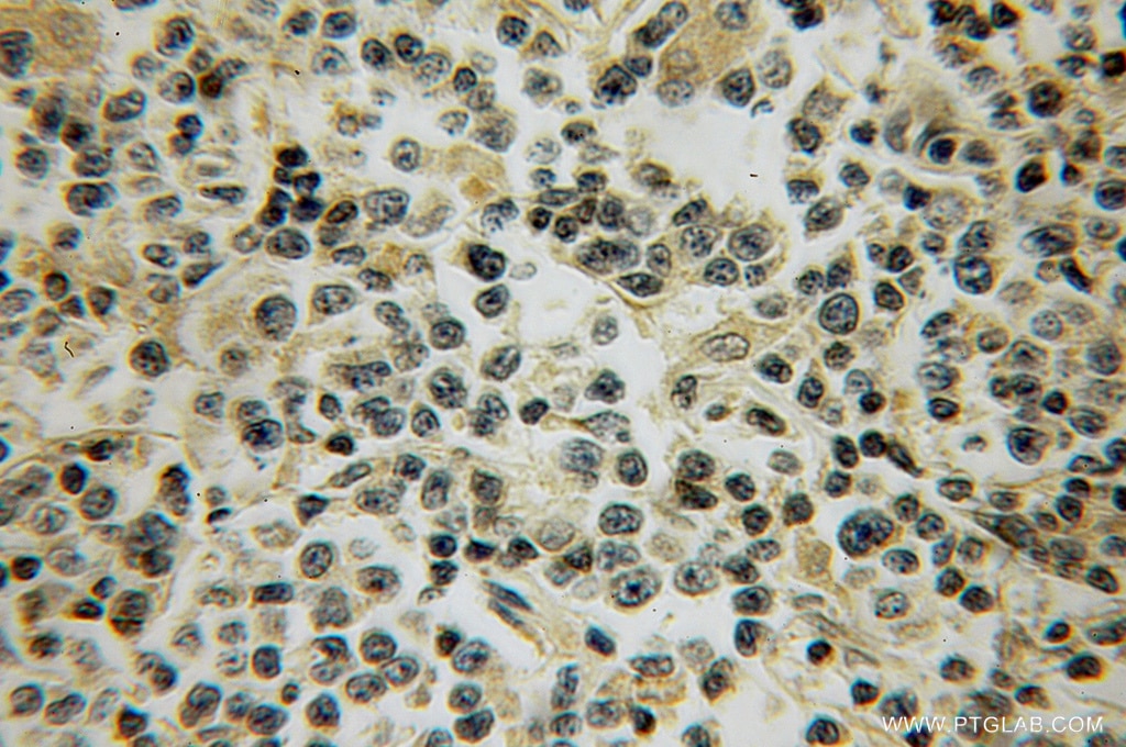 Immunohistochemistry (IHC) staining of human lymphoma tissue using CD97 Polyclonal antibody (13071-1-AP)