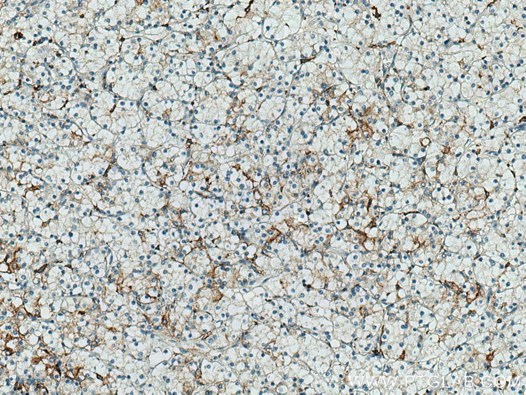 Immunohistochemistry (IHC) staining of human renal cell carcinoma tissue using CD98/SLC3A2 Monoclonal antibody (66883-1-Ig)