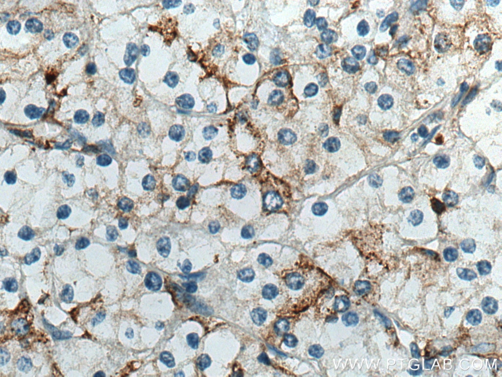 Immunohistochemistry (IHC) staining of human renal cell carcinoma tissue using CD98/SLC3A2 Monoclonal antibody (66883-1-Ig)