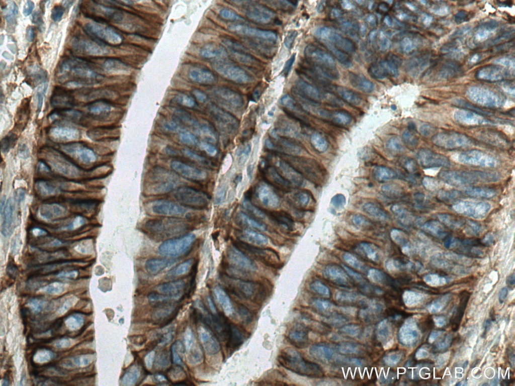 Immunohistochemistry (IHC) staining of human colon cancer tissue using CD98/SLC3A2 Monoclonal antibody (66883-1-Ig)