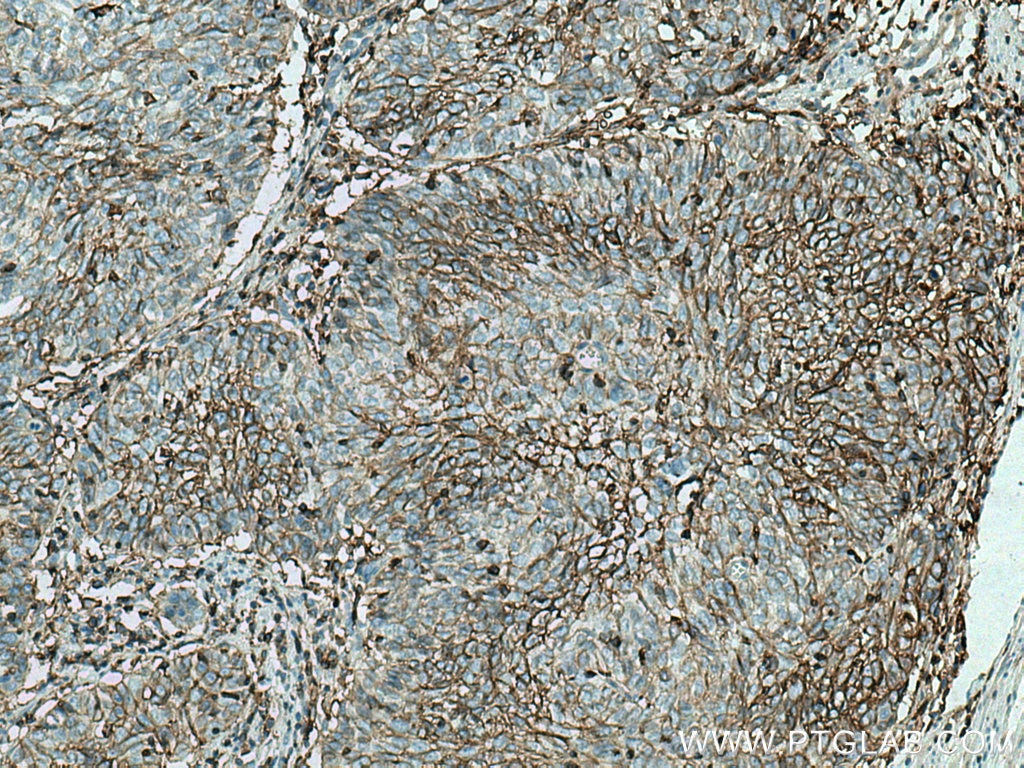 Immunohistochemistry (IHC) staining of human cervical cancer tissue using CD98/SLC3A2 Monoclonal antibody (66883-1-Ig)